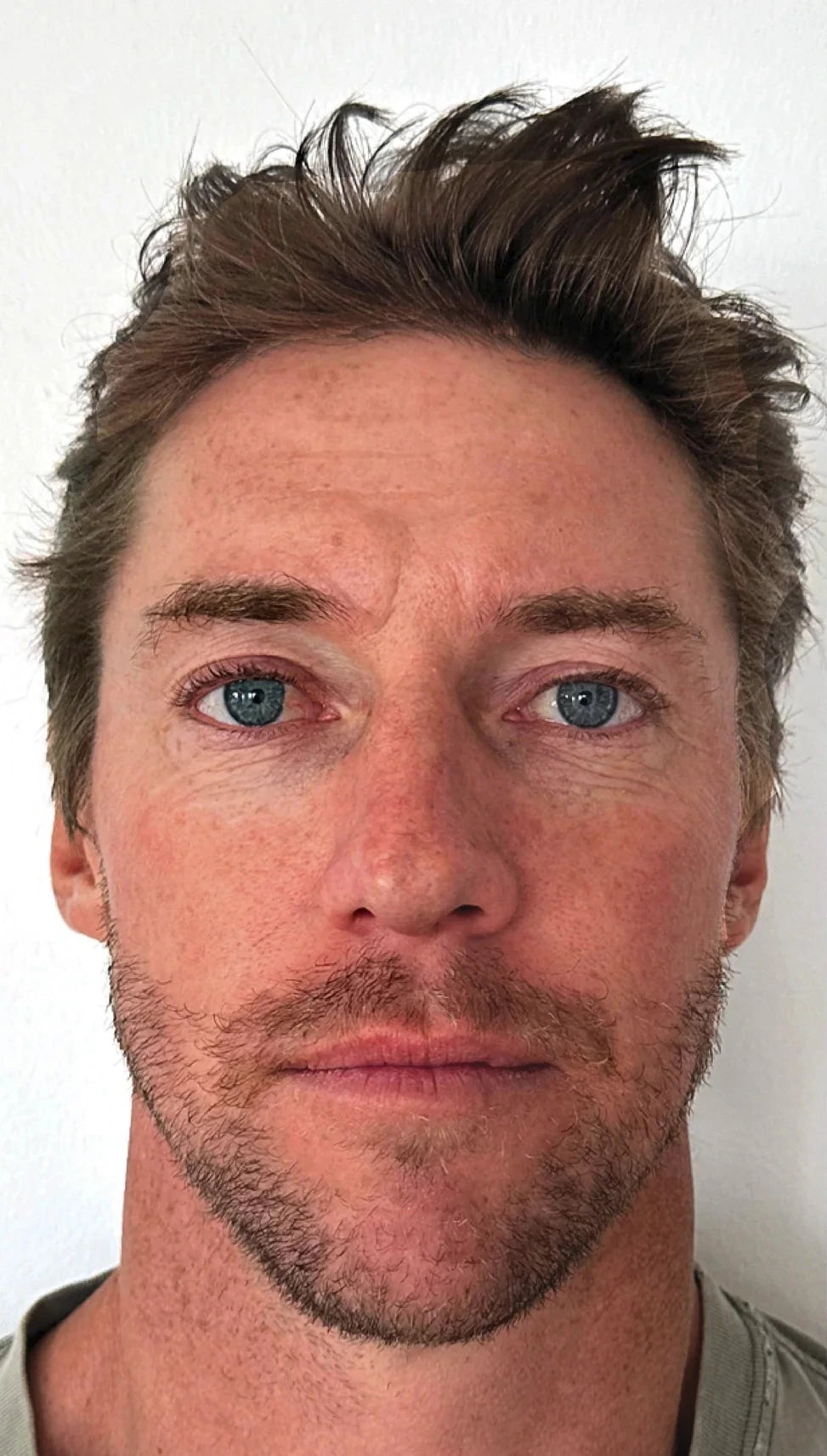 Before and after comparison of a man's face with 'Before' and 'After' labels.