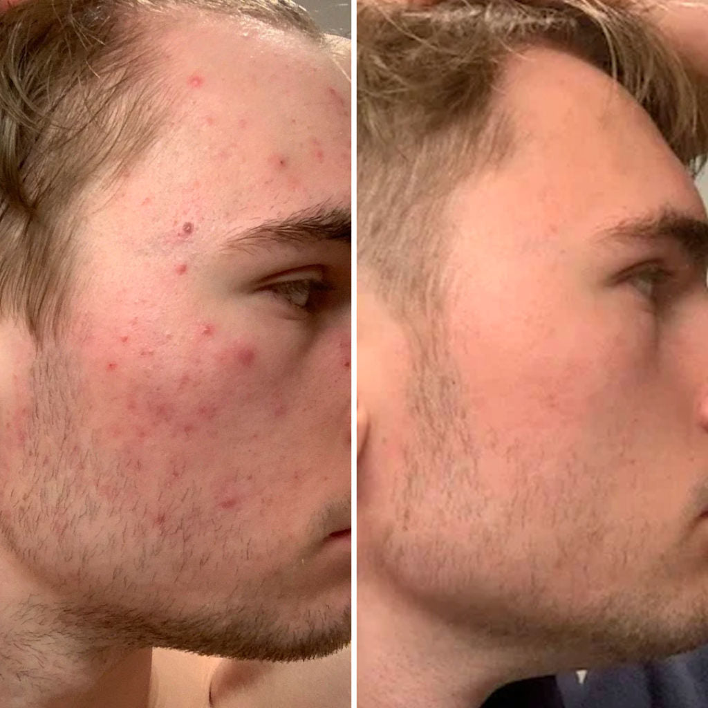 Before and after results from a SharpSkincare customer, showing a dramatic reduction in acne, breakouts, and redness on his cheek and jawline